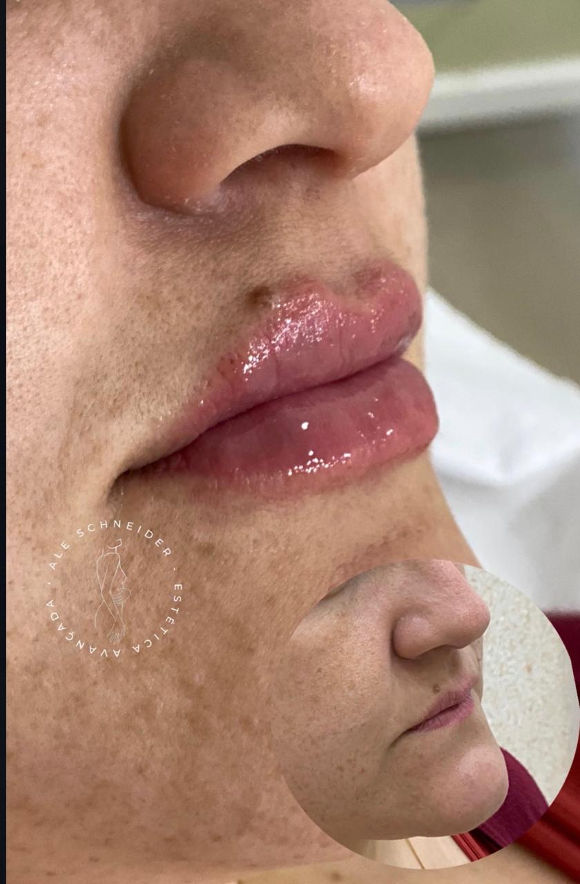 Preenchimento labial