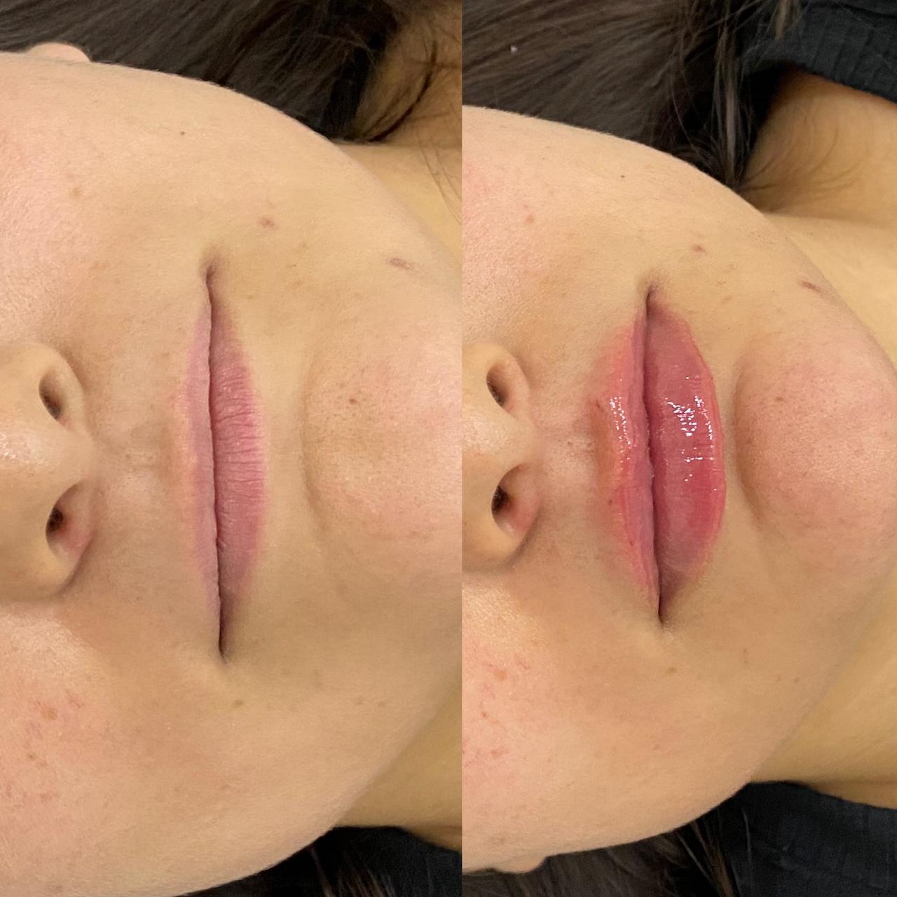 Preenchimento labial