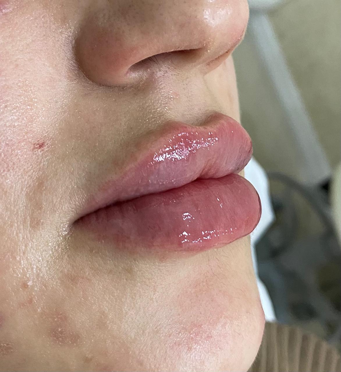 Preenchimento labial